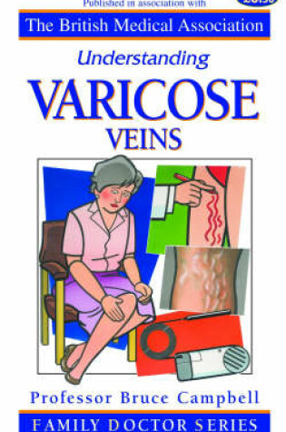 Cover of Understanding Varicose Veins