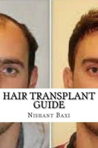 Cover of Hair Transplant Guide