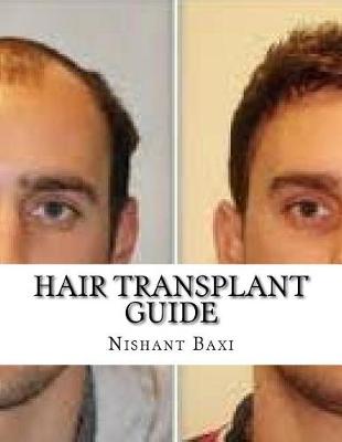 Book cover for Hair Transplant Guide