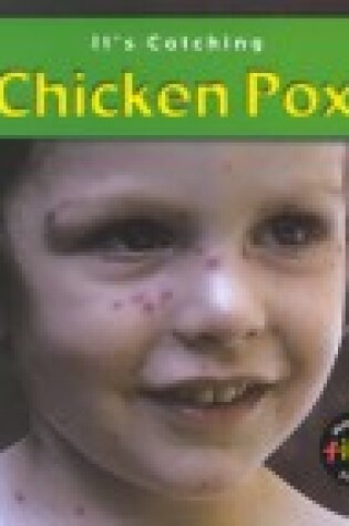 Cover of Chicken Pox