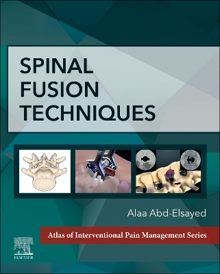 Book cover for Spinal Fusion Techniques - E-Book
