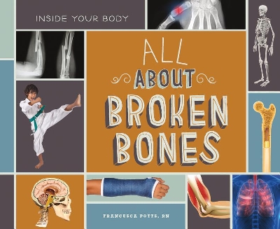 Cover of All about Broken Bones
