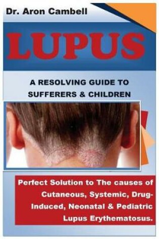 Cover of Lupus