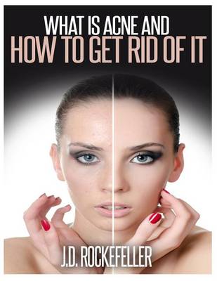 Book cover for What is Acne and How to Get Rid of It