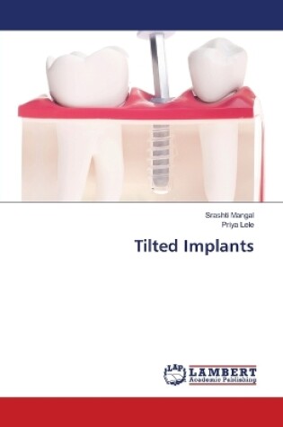 Cover of Tilted Implants