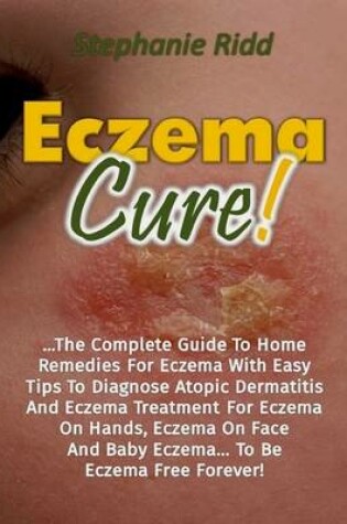 Cover of Eczema Cure!: The Complete Guide to Home Remedies for Eczema With Easy Tips to Diagnose Atopic Dermatitis and Eczema Treatment for Eczema On Hands, Eczema On Face and Baby Eczema... to Be Eczema Free Forever!