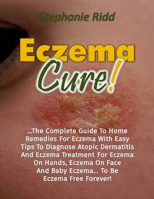 Book cover for Eczema Cure!: The Complete Guide to Home Remedies for Eczema With Easy Tips to Diagnose Atopic Dermatitis and Eczema Treatment for Eczema On Hands, Eczema On Face and Baby Eczema... to Be Eczema Free Forever!
