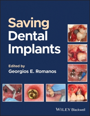 Book cover for Long–Term Survival of Dental Implants