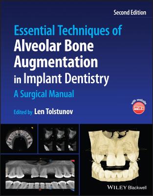 Cover of Essential Techniques of Alveolar Bone Augmentation in Implant Dentistry