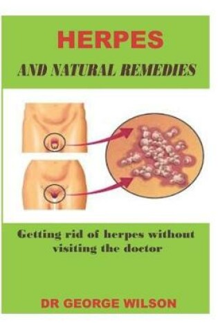 Cover of Herpes and Natural Remedies