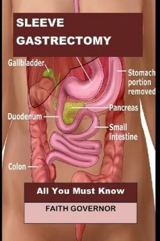 Cover of Sleeve Gastrectomy