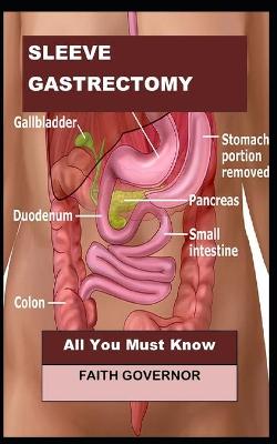 Book cover for Sleeve Gastrectomy