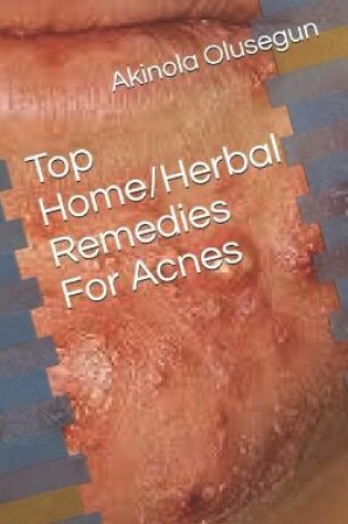 Cover of Top Home/Herbal Remedies For Acne