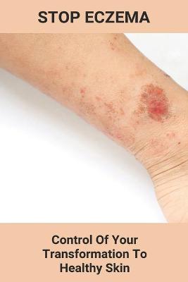 Book cover for Stop Eczema
