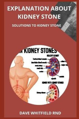 Cover of Explanation about Kidney Stone