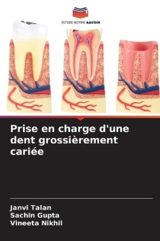 Cover of Prise en charge d'une dent grossi�rement cari�e