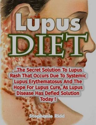 Book cover for Lupus Diet: The Secret Solution to Lupus Rash That Occurs Due to Systemic Lupus Erythematosus and the Hope for Lupus Cure, As Lupus Disease Has Defied Solution Today!