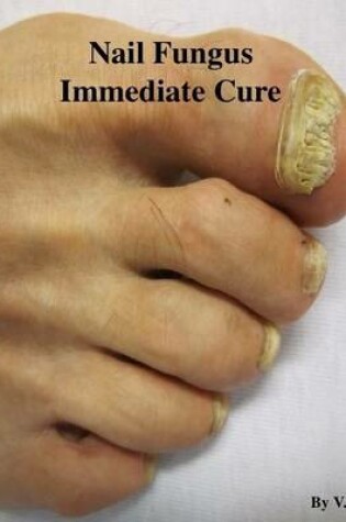 Cover of Nail Fungus Immediate Cure