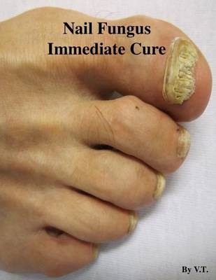 Book cover for Nail Fungus Immediate Cure