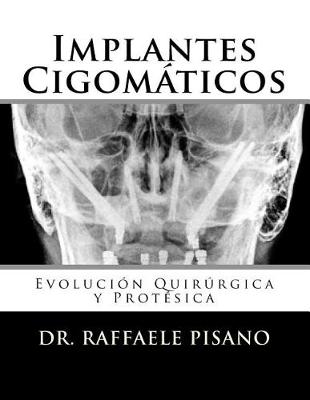 Book cover for Implantes Cigomáticos