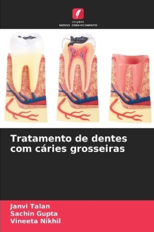 Cover of Tratamento de dentes com c�ries grosseiras