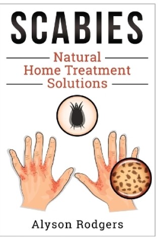 Cover of Scabies Natural Home Treatment Solution