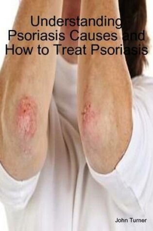 Cover of Understanding Psoriasis Causes and How to Treat Psoriasis