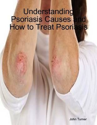 Book cover for Understanding Psoriasis Causes and How to Treat Psoriasis