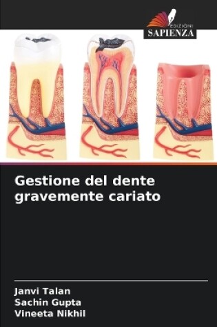 Cover of Gestione del dente gravemente cariato