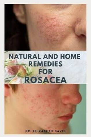 Cover of Natural and Home Remedies for Rosacea