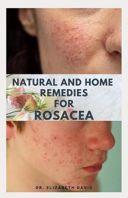 Book cover for Natural and Home Remedies for Rosacea