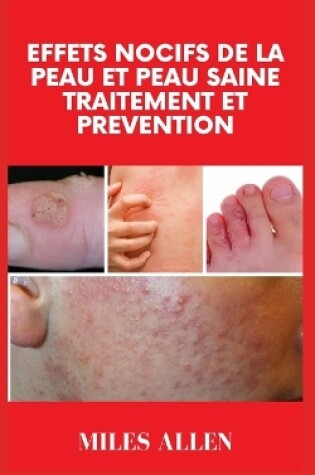 Cover of Effets Nocifs de la Peau Et Peau Saine Traitement Et Prevention