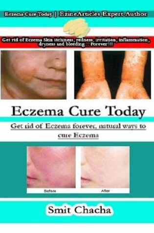 Cover of Eczema Cure Today: Get Rid of Eczema Forever, Natural Ways to Cure Eczema