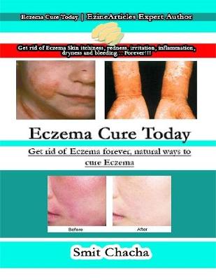 Book cover for Eczema Cure Today: Get Rid of Eczema Forever, Natural Ways to Cure Eczema