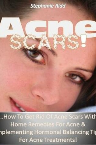 Cover of Acne Scars! …How to Get Rid of Acne Scars With Home Remedies for Acne and Implementing Hormonal Balancing Tips for Acne Treatments!